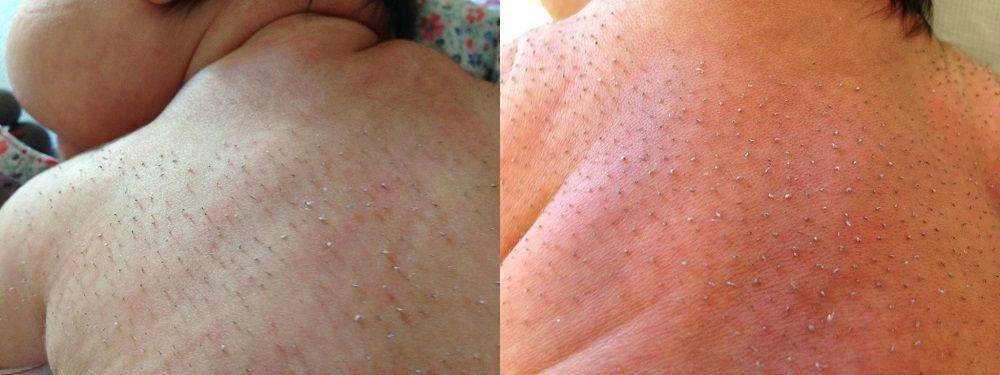 Figura 1. Lesiones puntiformes milimétricas negras en espalda